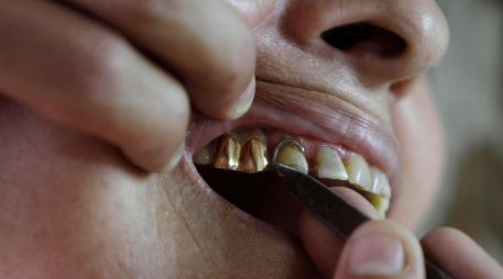 Especialistas resaltaron que la clave para evitar estos problemas es atender la salud dental desde la infancia, lo que evitará que en la edad adulta haya problemas. AP / ARCHIVO